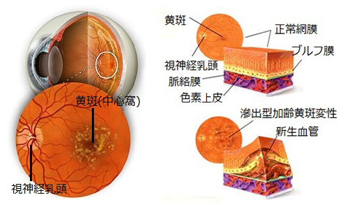 黄斑変性・網膜