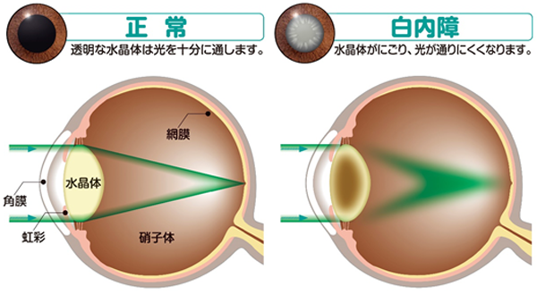 白内障と視力低下