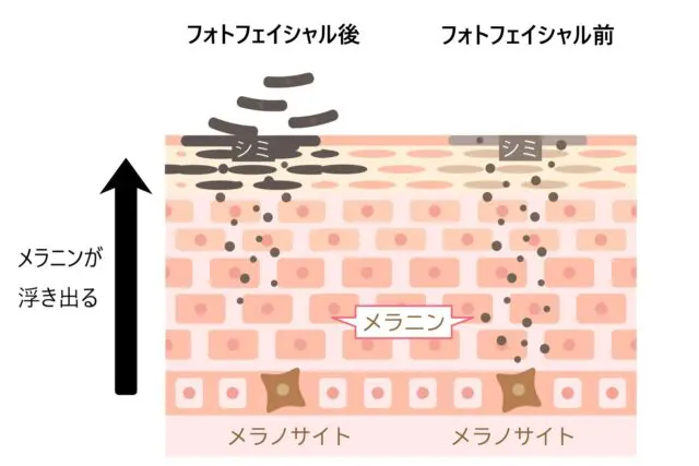 シミ・そばかす・くすみの改善