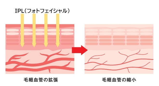 赤ら顔・毛細血管拡張の改善（血管収縮・ヘモグロビン吸収）