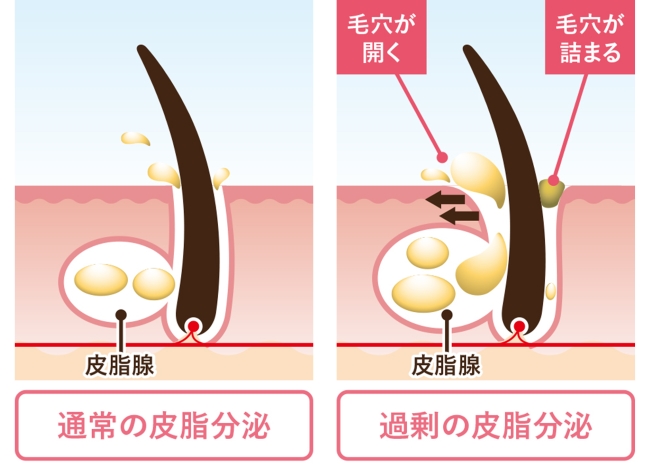 毛穴の引き締め・ニキビ改善