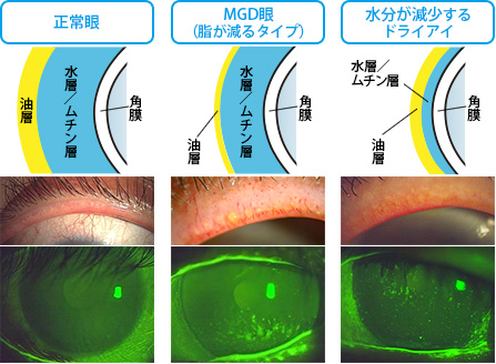 ドライアイの分類