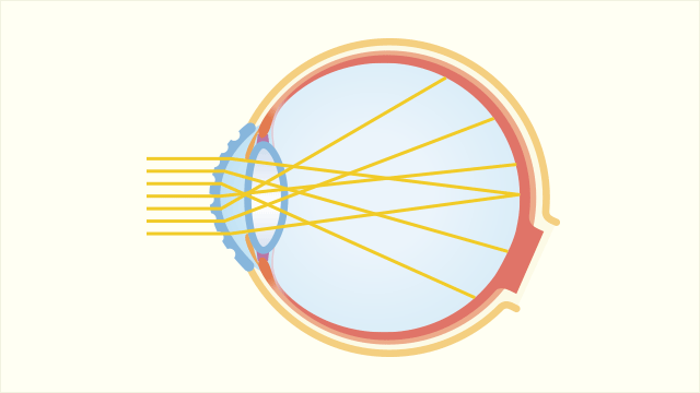 不正乱視（ICL（眼内コンタクト）では矯正できません）