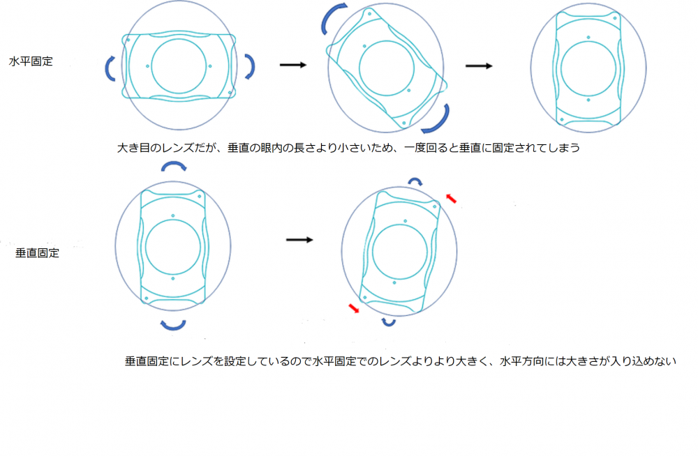 垂直固定は眼内コンタクトが安定しやすい