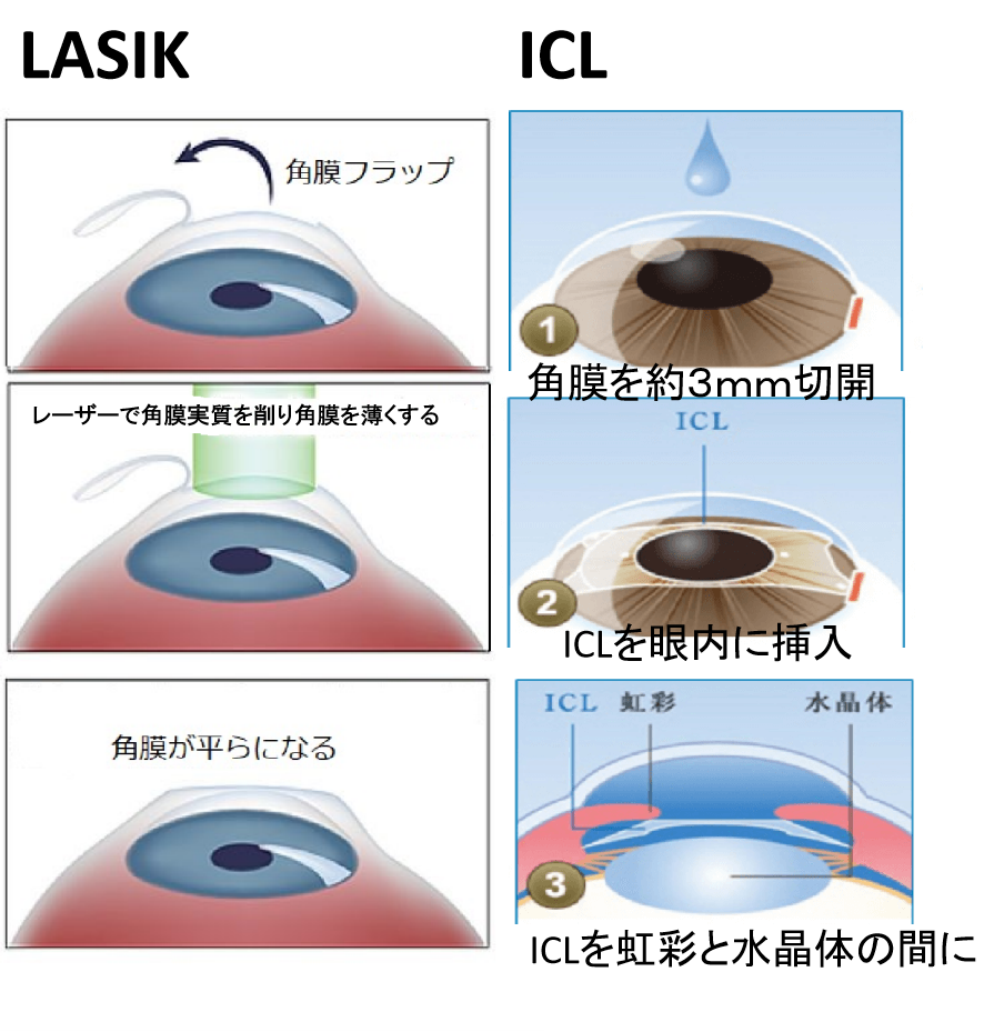 術式の考え方の違い ―LASIK（レーシック）とICL（眼内コンタクト）―