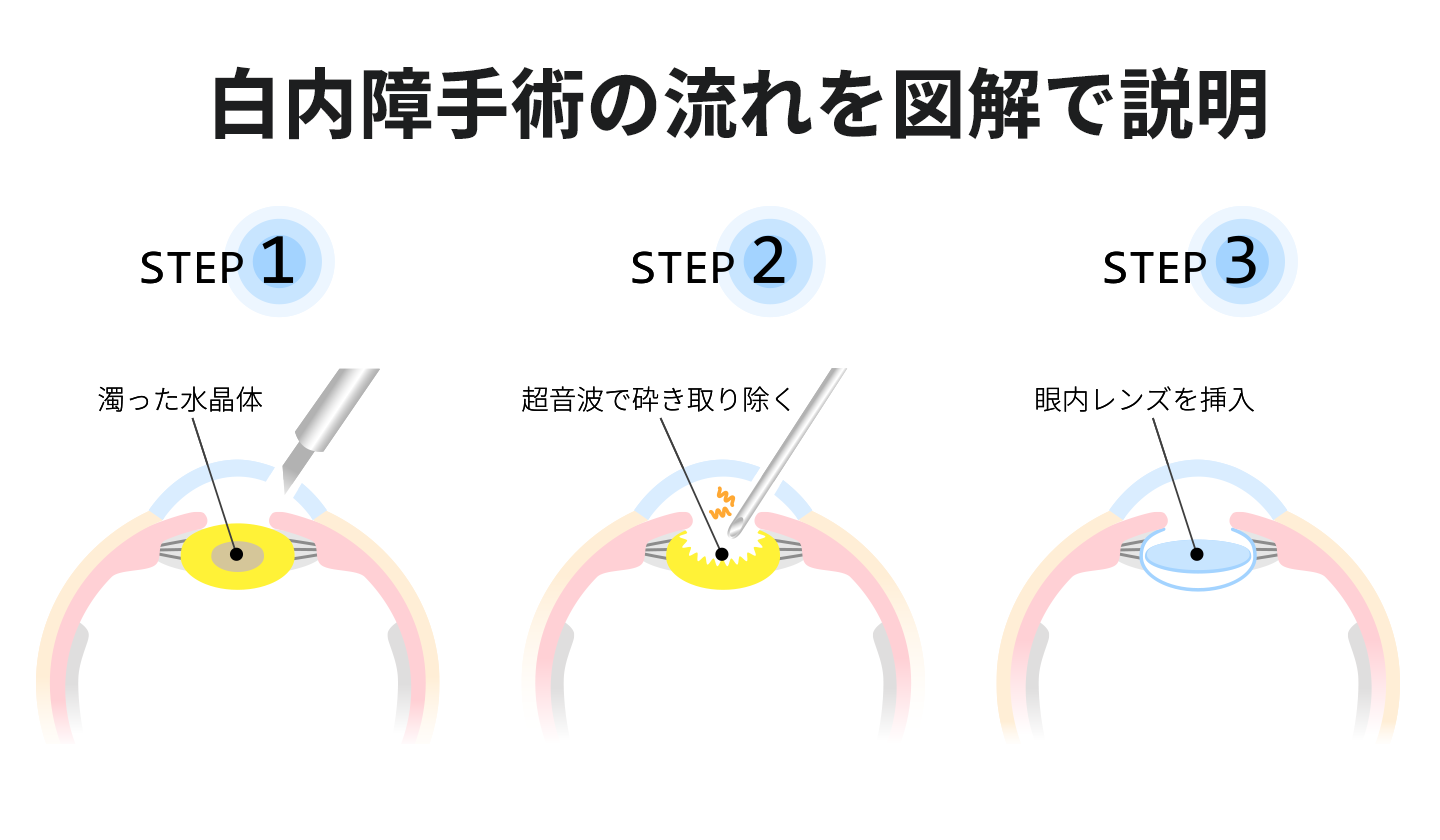 白内障手術とは