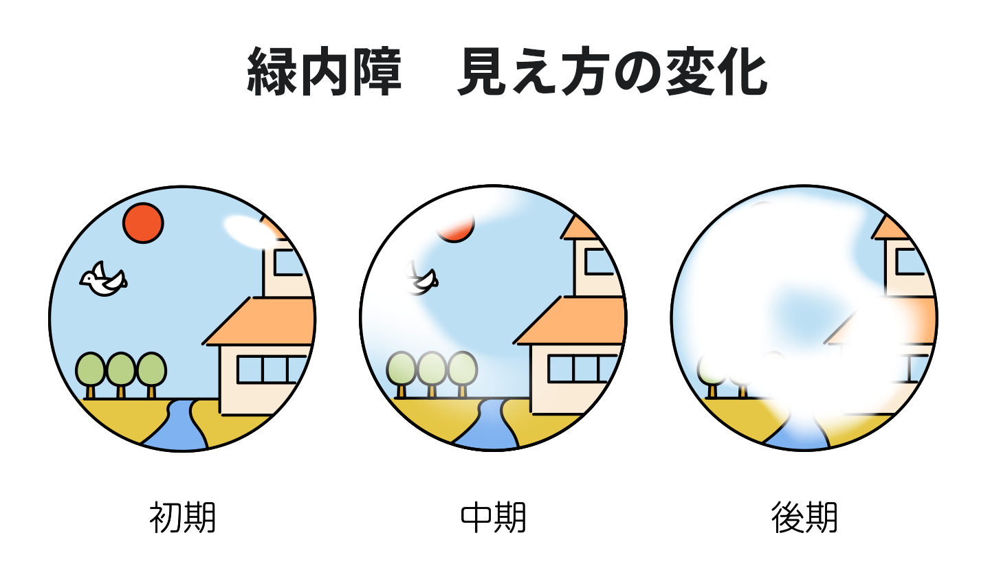 緑内障診療