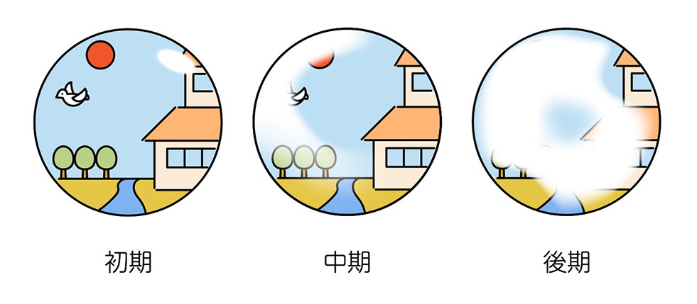緑内障の初期・中期・後期における見え方の比較