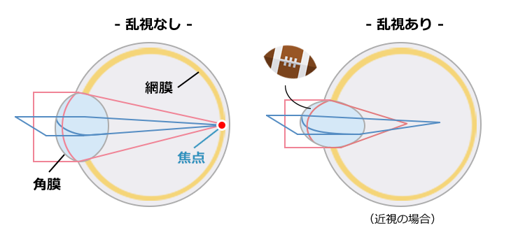 正乱視|乱視用ICLで矯正可能